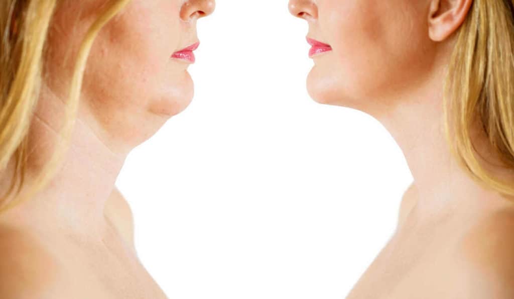 Double Chin treatment Eastcote before and after results