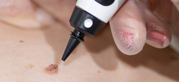 After Skin Tag Removal Eastcote