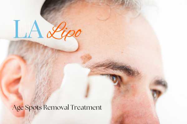What Are the Most Effective Treatments for Age Spots Eastcote?