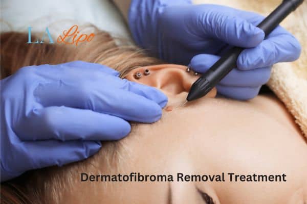 Dermatofibroma Removal Treatment Eastcote