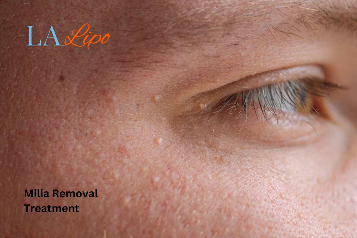 Cryopen Milia Removal: Is It the Easiest and Safest Option Eastcote?