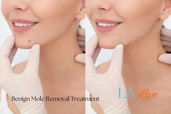 woman's before and after mole removal Eastcote results