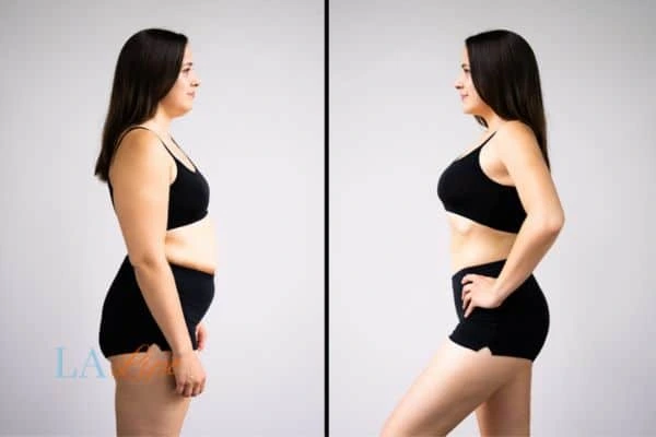 image of woman before and after results of LA-EMS Body Sculpting Eastcote to help treat Diastasis recti