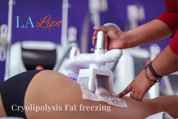 women getting fat freezing Eastcote