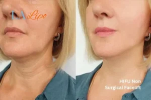 hi-fu for wrinkles Eastcote before and after results