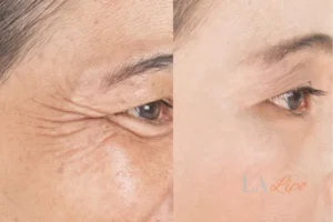Before and after results of woman - HI-fu wrinkles reduction treatment Eastcote