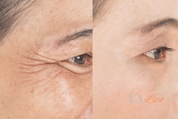 Before and after results of woman - HI-fu wrinkles reduction treatment Eastcote