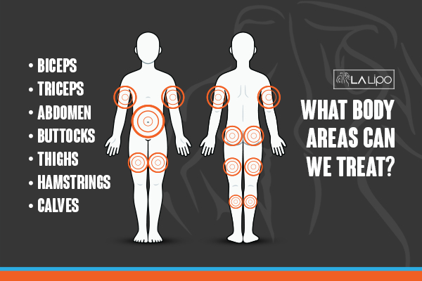 Graphic to show areas you can have LA-EMS Body Sculpting Eastcote treatment.