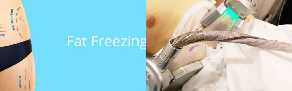 Fat freezing Eastcote on multiple areas of the body