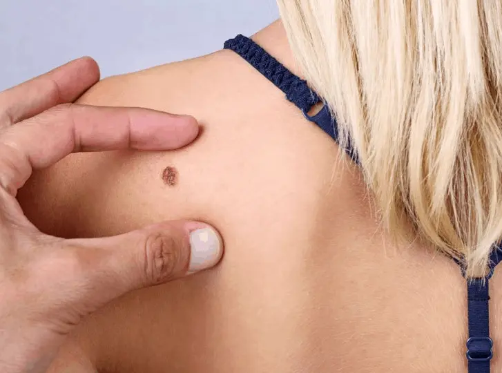 woman having mole removal Eastcote consultation before treatment.