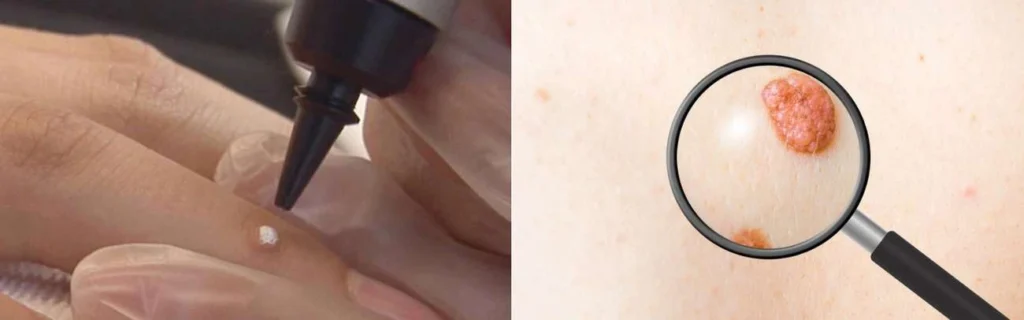 CryoPen practitioner Eastcote assessing a benign mole before treatment