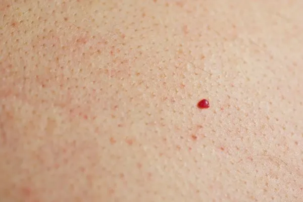 close up of a cherry angioma Eastcote