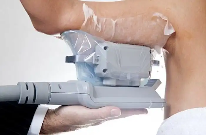 Picture of fat freezing Eastcote on the upper arms.