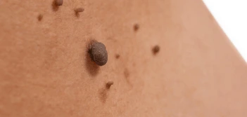 image of a skin tag Eastcote