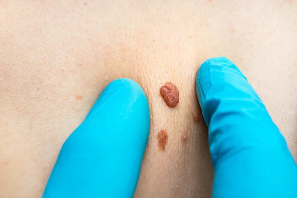Consultant examining a skin tag Eastcote