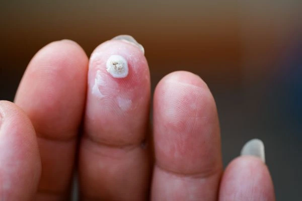 wart on person finger - cryotherapy to treat from LA LIPO Eastcote