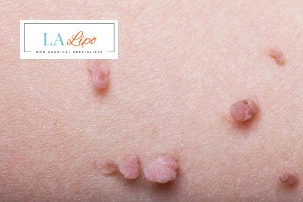 Does cryopen skin tag removal Eastcote hurt? Find out now call our team today!