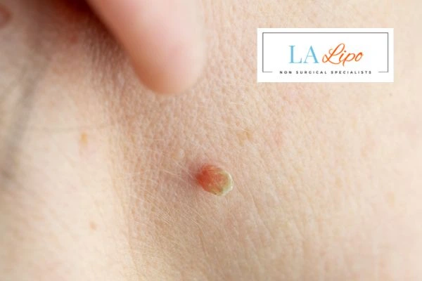 Book skin tag removal Eastcote today speak to our team now!