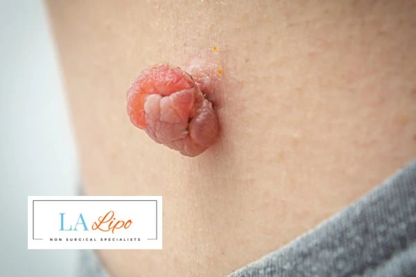 Interested in skin tag removal Eastcote? Concerned about the pain? Find out more today!