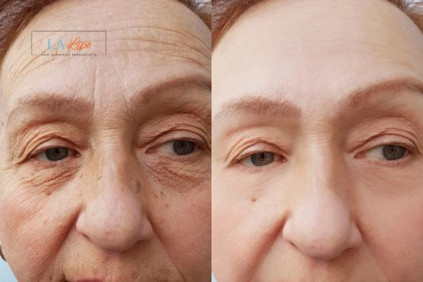The powerful benefits of Morpheus8 Treatment Eastcote - Call Our team today!