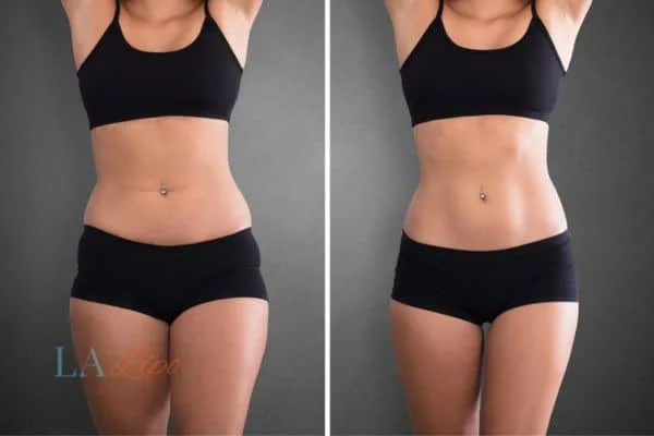 before and after results of non-surgical treatment to help a woman's body image and mental health Eastcote