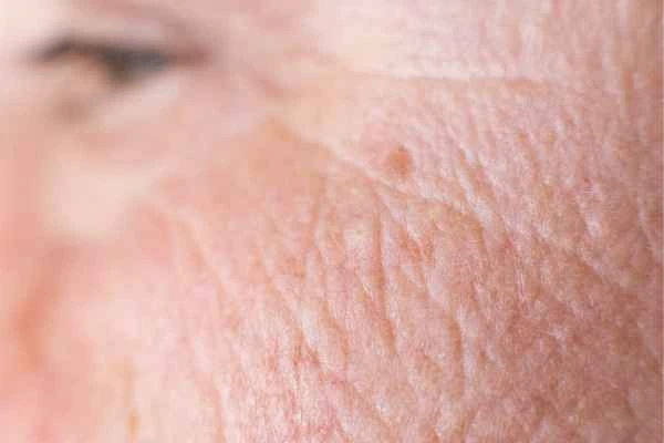 close up picture of a woman's face showing an age spot Eastcote