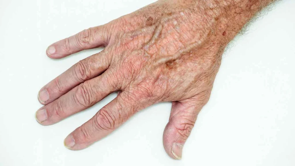 Male hand showing age spot Eastcote