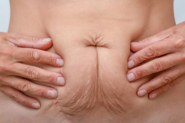 Image of a woman's stomach with loose skin - example of skin tightening Eastcote options