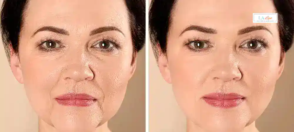 How Long Does It Take to See Results and How Long Do They Last Eastcote?