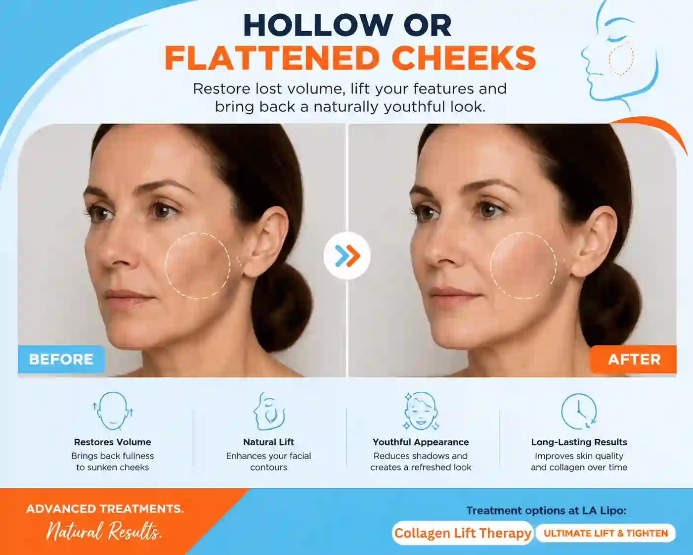 Sign #4: Hollow or Flattened Cheeks Eastcote